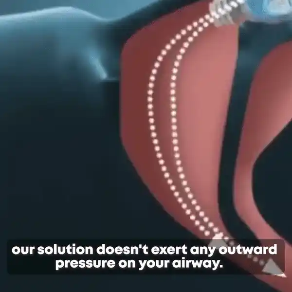 Anti-Snoring Device